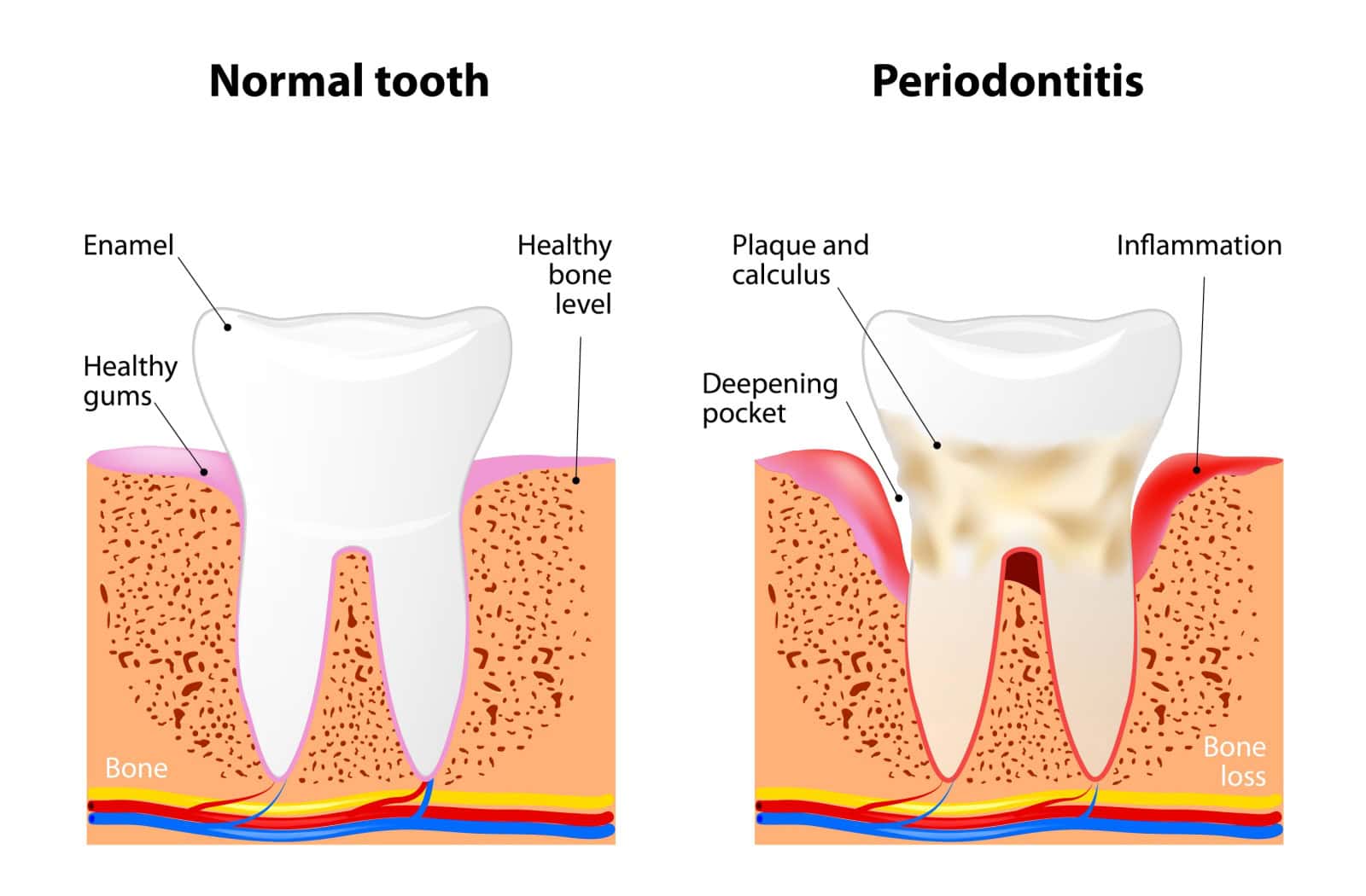 Graphic showing a normal tooth compared to one with inflammation and damage due to periodontitis.