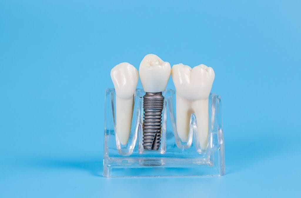 Model of two teeth and an implant.