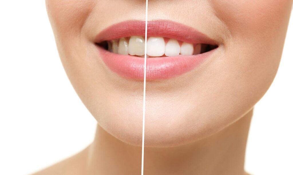 Result of teeth whitening on a woman smiling, before and after. 