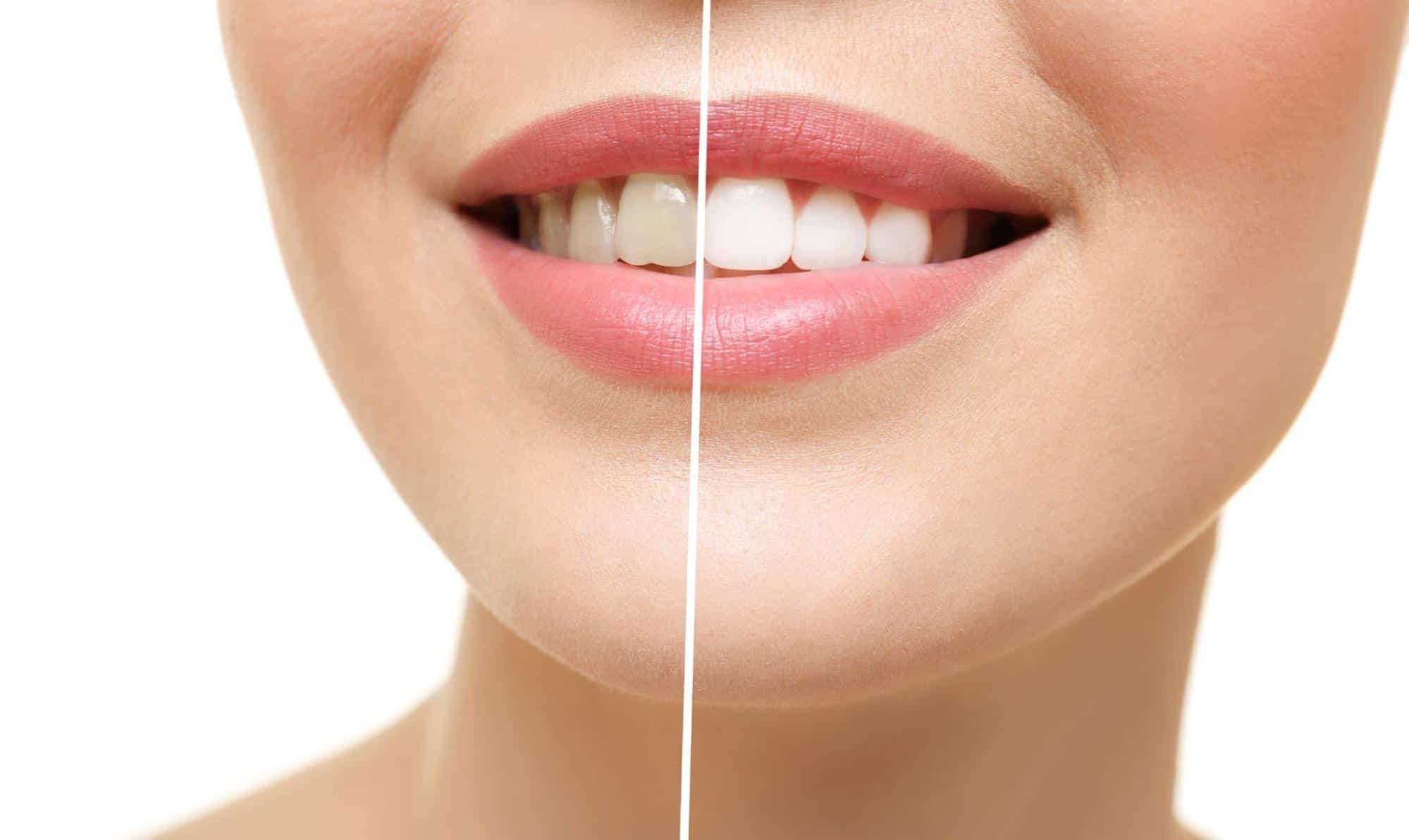 Are Yellow Teeth South Ancaster Family Dental