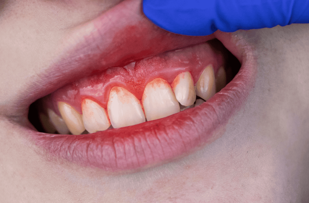 Inflamed, irritated gums showing signs of gum disease are investigated by a dentist.