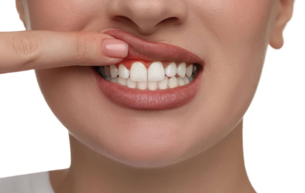 A person with mild gum disease lifts their top lip with their finger to show their red, swollen gums.