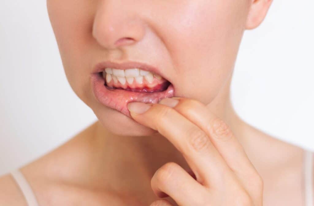 An adult with two fingers pulling open mouth revealing lower teeth with inflammation of the gums.