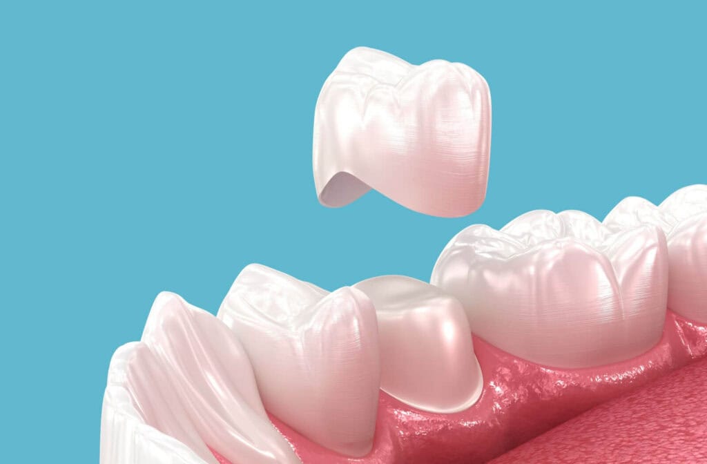 3D close up illustration of a crown on top of a filed down tooth.