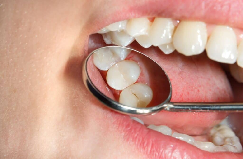 Close-up of an Ancaster dentist using a mirror to check for cavities on a patient’s molars during a dental exam.