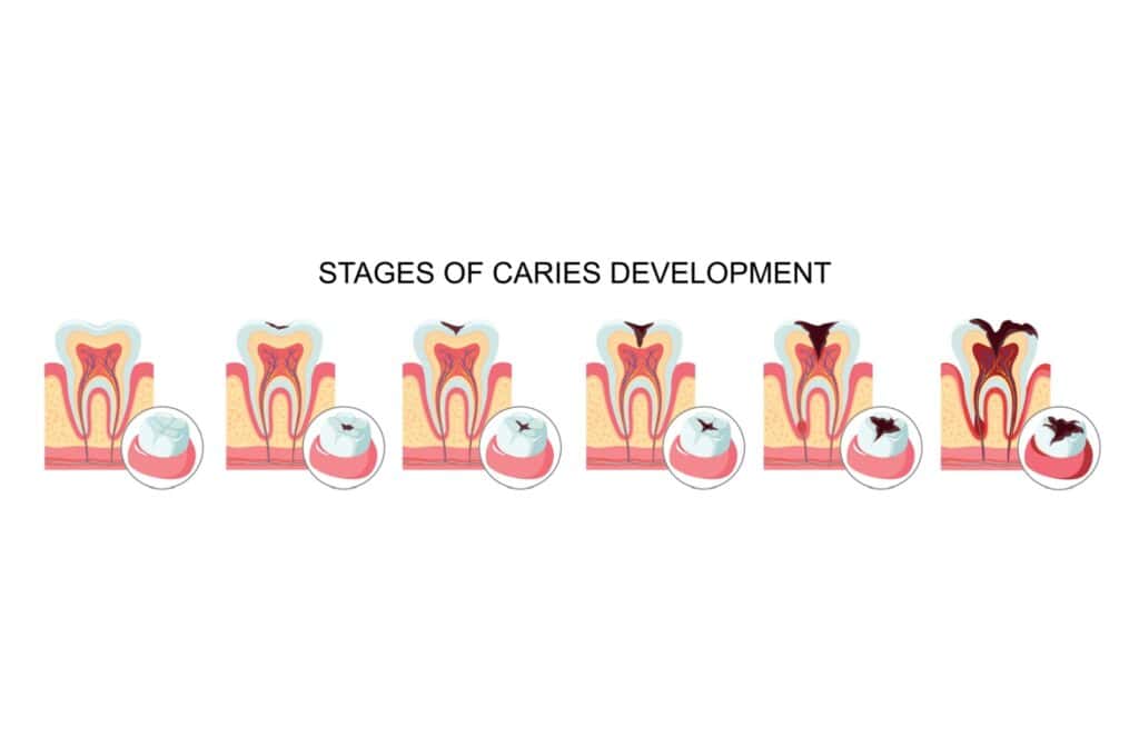 Illustration showing the stages of cavity development, used by an Ancaster dentist to explain how decay progresses from enamel to deeper layers.
