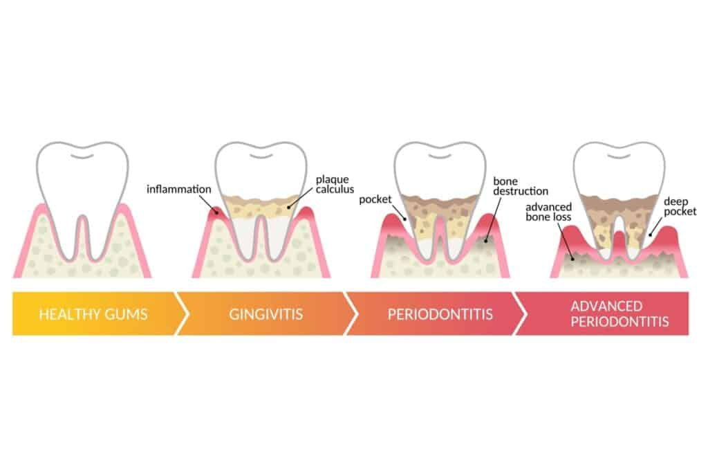 Illustration showing the stages of gum disease from healthy gums to gingivitis, periodontitis, and advanced periodontitis, with inflammation, plaque buildup, pockets, and bone loss.