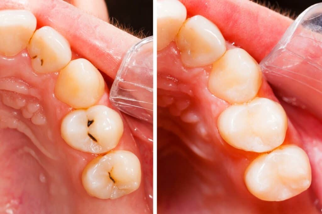 Side-by-side close-up photos of upper molars showing dark cavities before treatment and the same teeth after receiving tooth-colored fillings.
