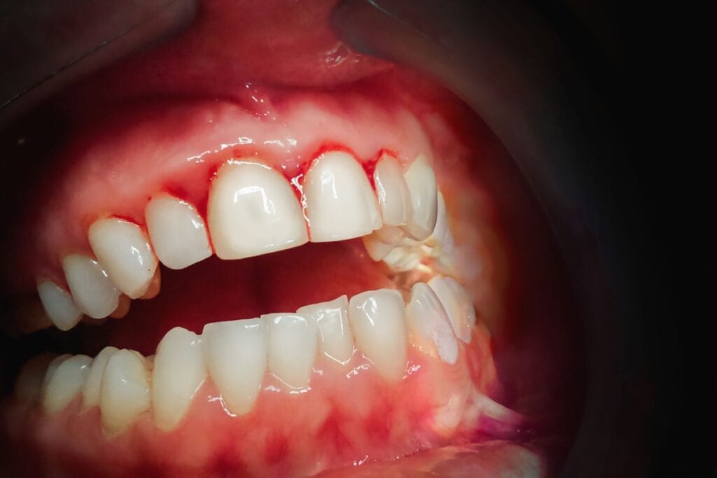 Close-up view of upper and lower front teeth showing red, inflamed gums with visible bleeding along the gum line.
