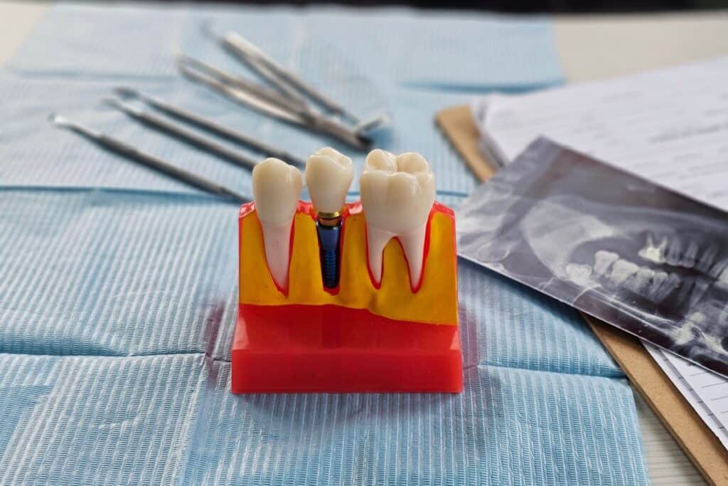Dental model showing a tooth implant between two natural teeth, placed on a blue dental tray with instruments and an X-ray nearby.
