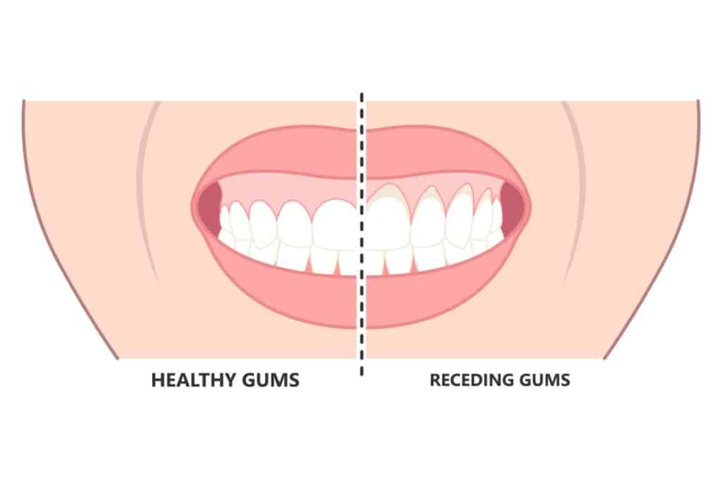 Split comparison diagram showing healthy gums on the left with gum tissue covering teeth properly versus receding gums on the right with gum tissue pulled away from teeth exposing tooth roots and creating visible gaps.