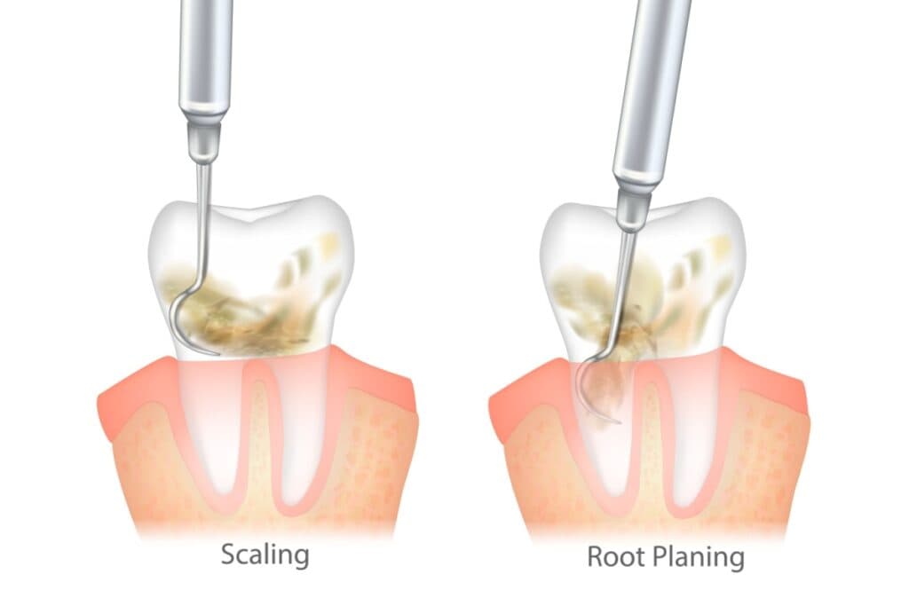 Side-by-side dental diagram comparing scaling and root planing procedures showing dental instruments removing tartar from below the gum line, with the left image demonstrating scaling to remove buildup and the right image showing root planing to smooth tooth root surfaces.