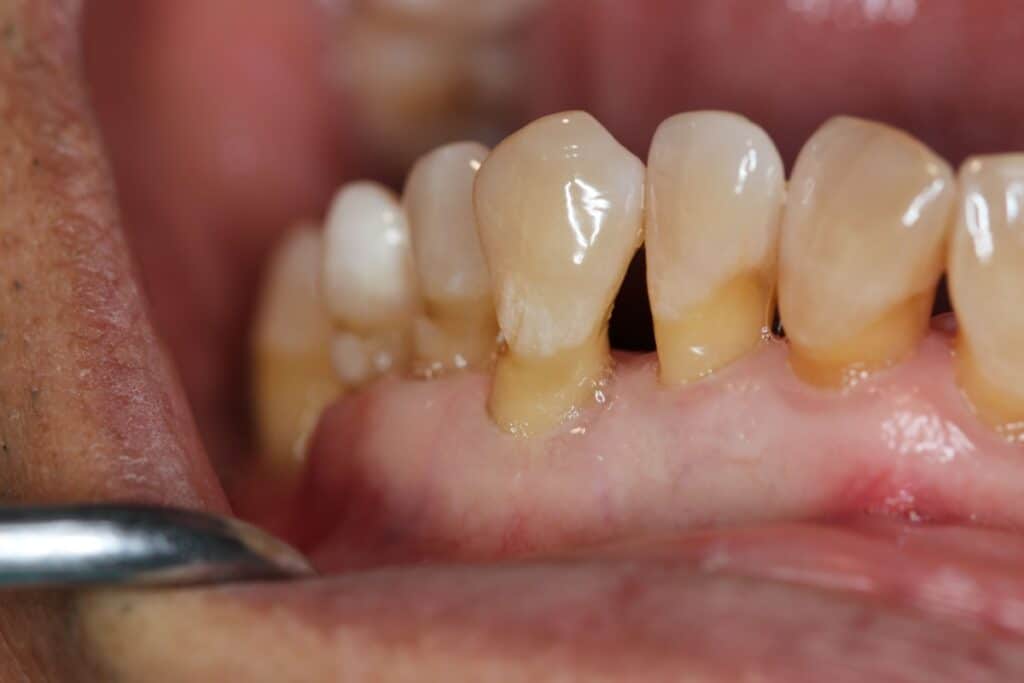 Close-up clinical photograph showing severe gum recession with exposed tooth roots, visible gaps between teeth and gums, and gum tissue pulled away from teeth revealing darker root surfaces and dental probe examining the affected area.