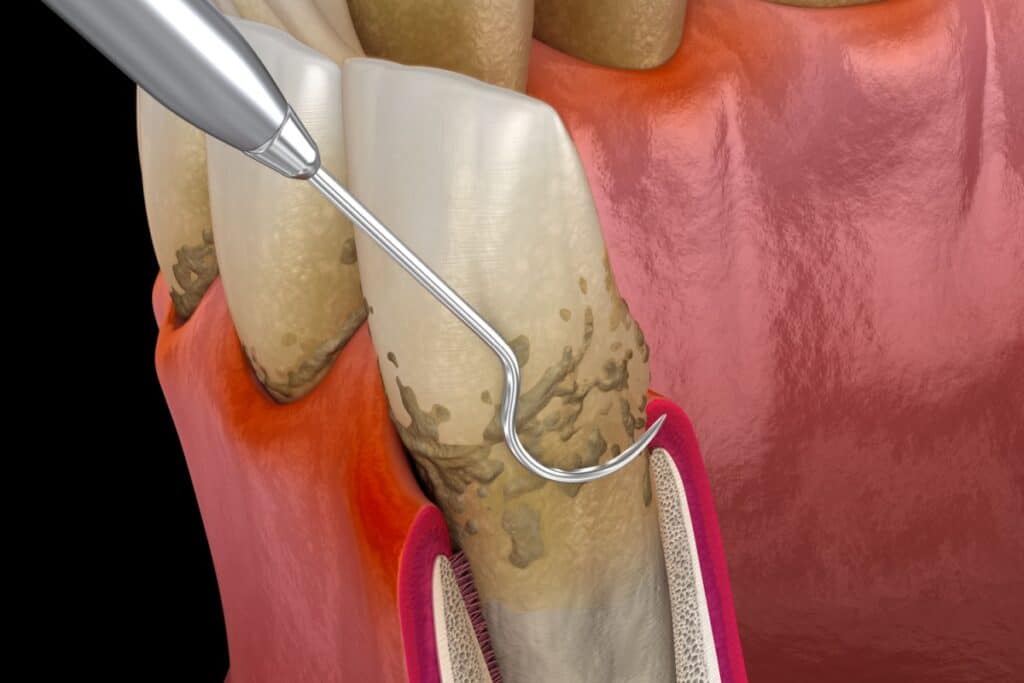 Close-up illustration of dental scaling procedure showing a scaler instrument removing tartar buildup from below the gum line on tooth roots, with inflamed gum tissue visible showing signs of gum disease.