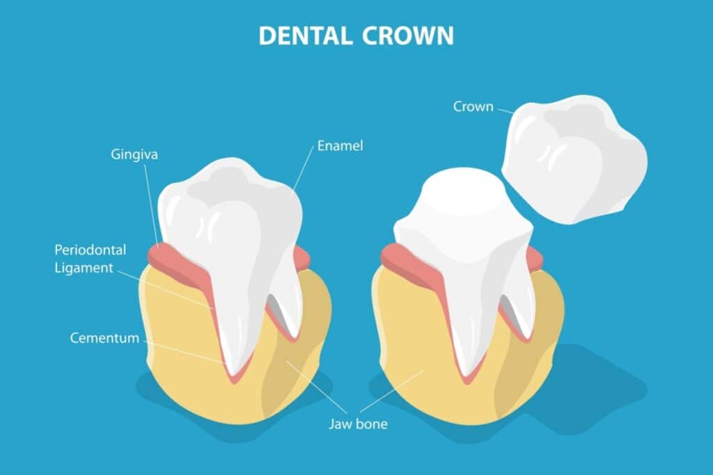 Educational diagram illustrating dental crown placement and tooth anatomy, showing labeled parts including gingiva, enamel, periodontal ligament, cementum, and jaw bone.
