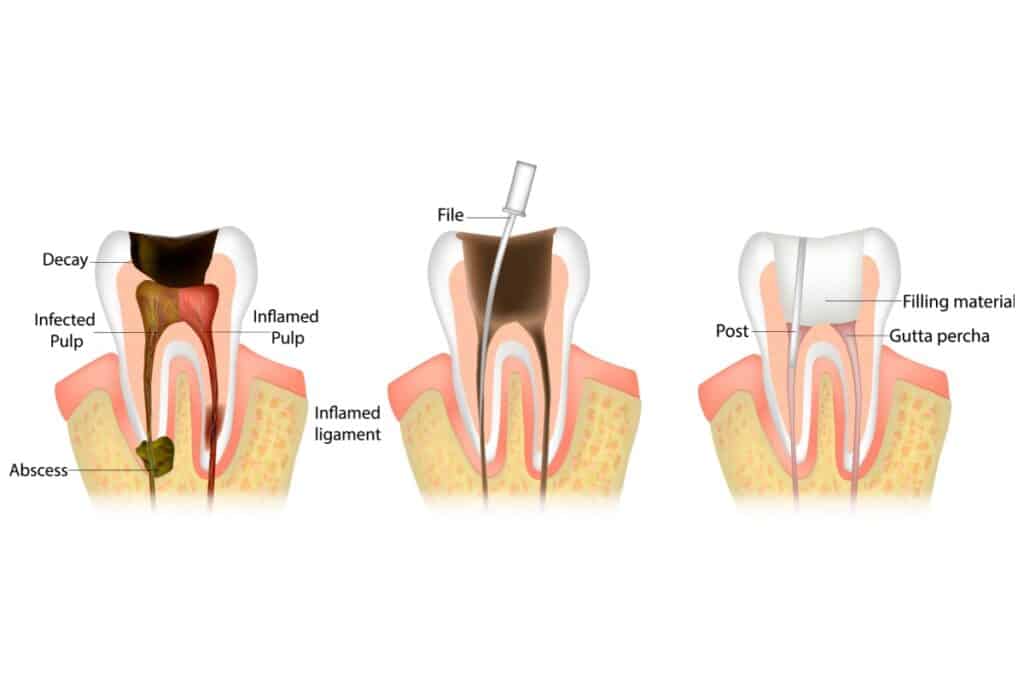 A step-by-step diagram of a tooth undergoing a root canal procedure, showing decay and infection, cleaning with a file, and sealing with filling material.