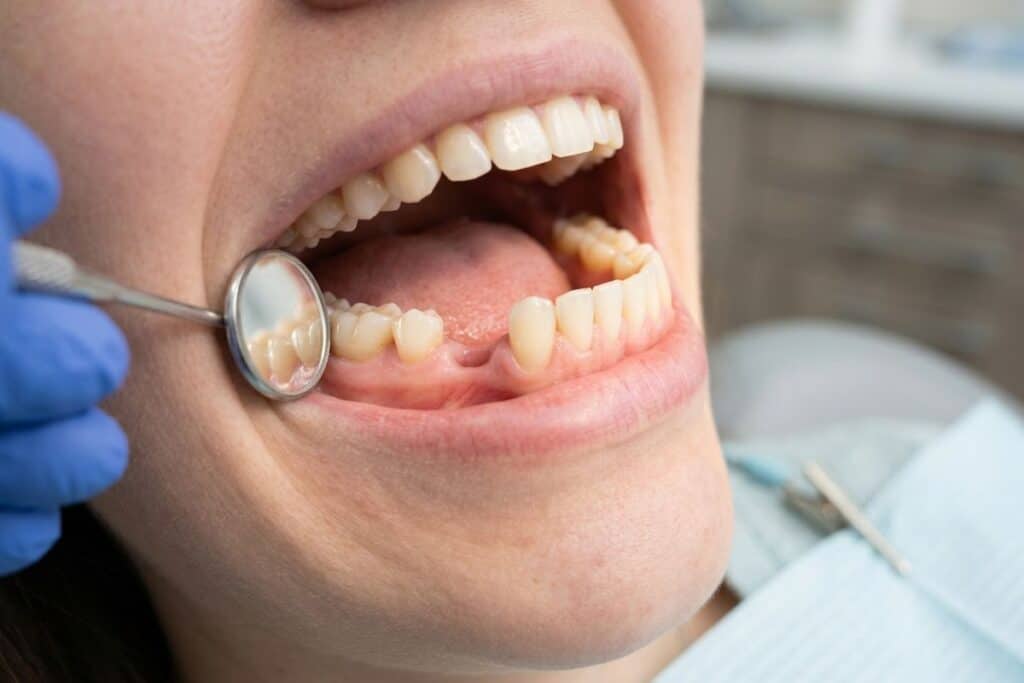 Close-up of a patient’s open mouth during a dental exam, with a gloved hand holding a dental mirror near the lower teeth.